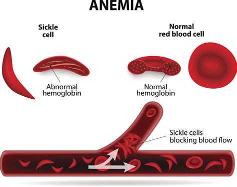 sickle cell anemia bone marrow transplant
